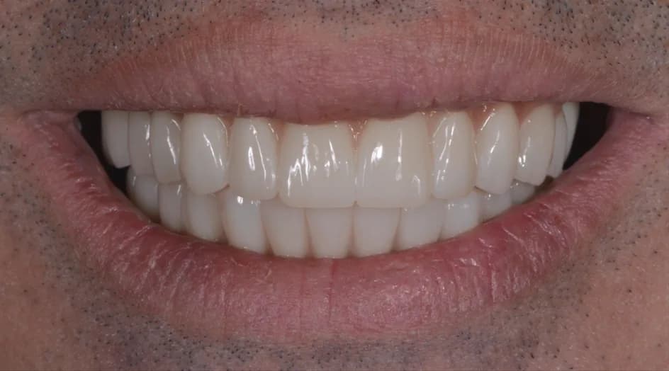 All-on-X Implants – after treatment, case 1 – Uptown Dentistry