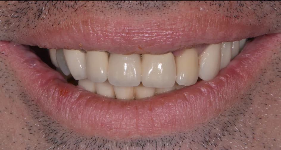 All-on-X Implants – before treatment, case 1 – Uptown Dentistry