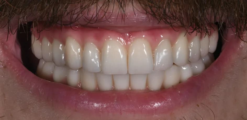 All-on-X Implants – after treatment, case 2 – Uptown Dentistry