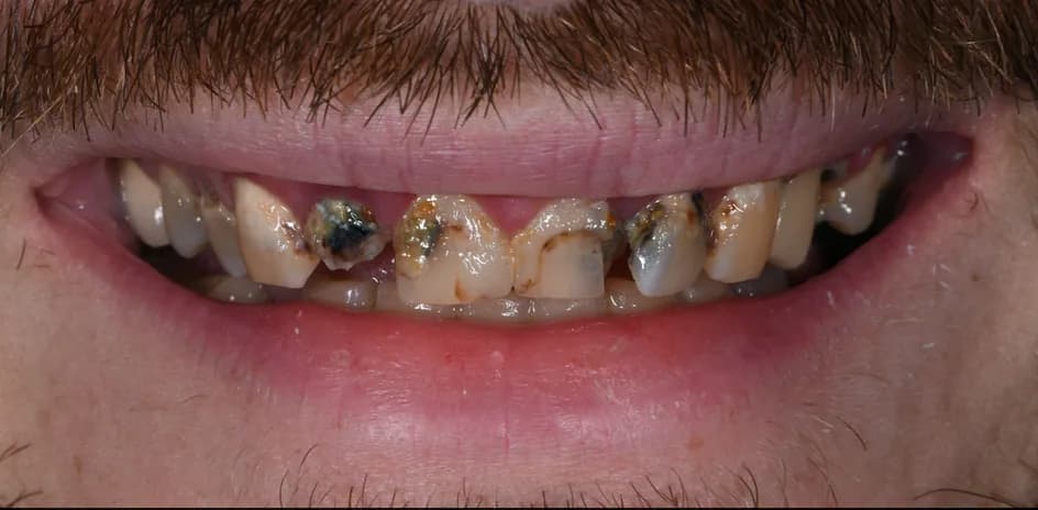 All-on-X Implants – before treatment, case 2 – Uptown Dentistry