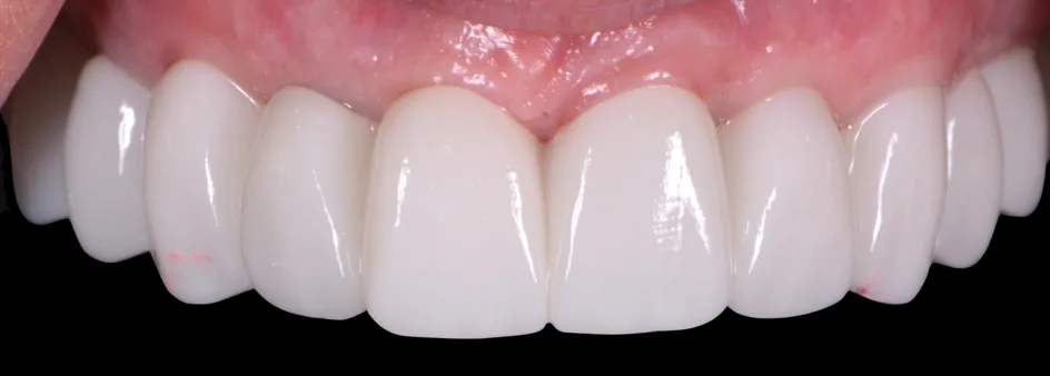 All-on-X Implants – after treatment, case 3 – Uptown Dentistry