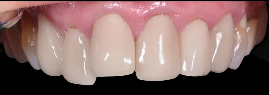 All-on-X Implants – before treatment, case 3 – Uptown Dentistry