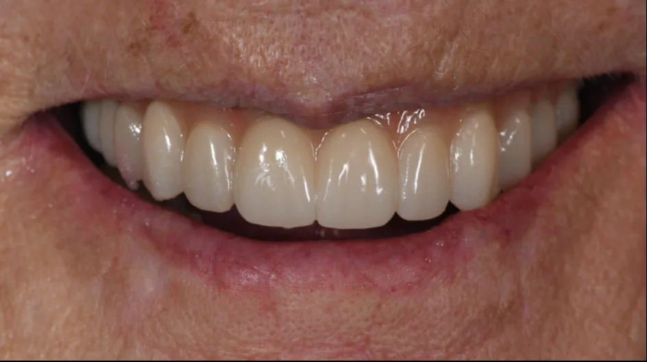 All-on-X Implants – after treatment, case 4 – Uptown Dentistry