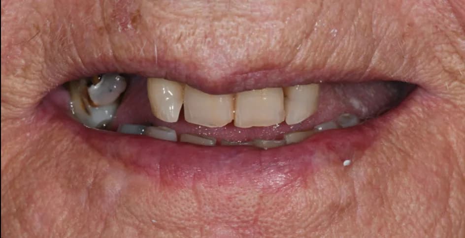 All-on-X Implants – before treatment, case 4 – Uptown Dentistry