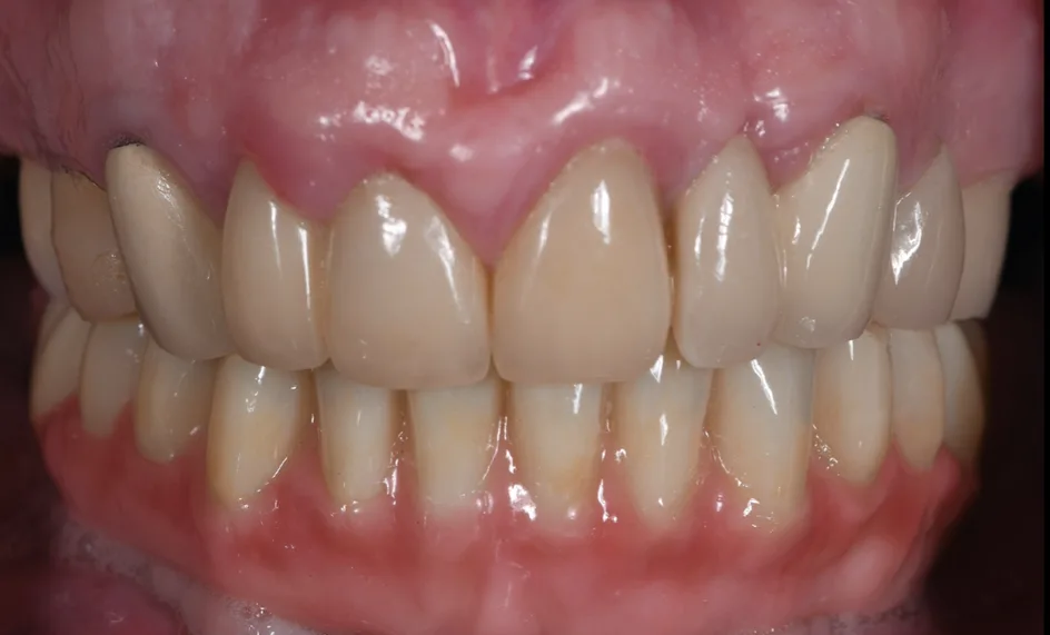 All-on-X Implants – after treatment, case 5 – Uptown Dentistry