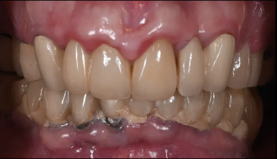 All-on-X Implants – before treatment, case 5 – Uptown Dentistry