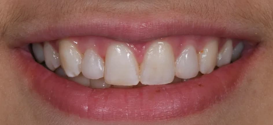 Bonding – after treatment, case 1 – Uptown Dentistry