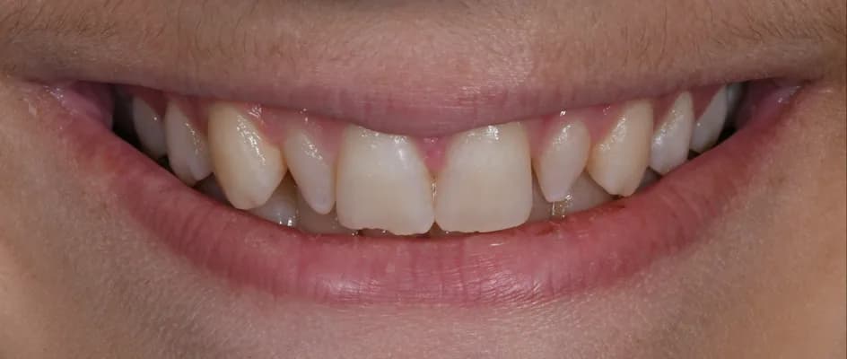 Bonding – before treatment, case 1 – Uptown Dentistry