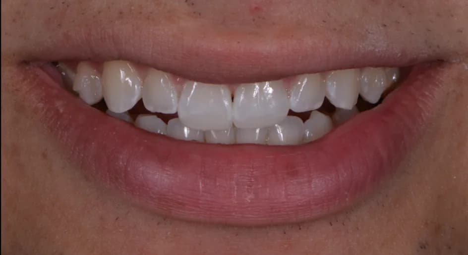 Bonding – after treatment, case 2 – Uptown Dentistry