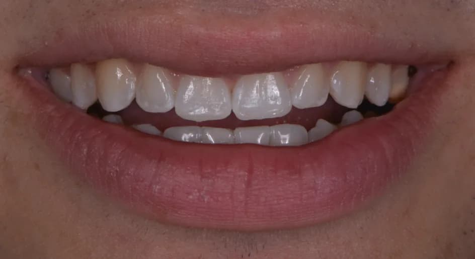 Bonding – before treatment, case 2 – Uptown Dentistry