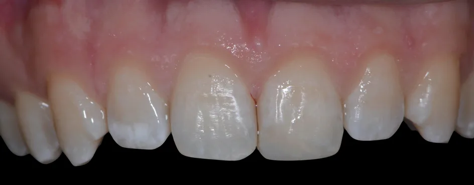 Bonding – after treatment, case 3 – Uptown Dentistry