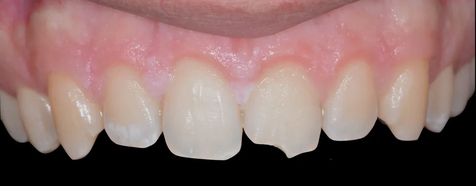 Bonding – before treatment, case 3 – Uptown Dentistry