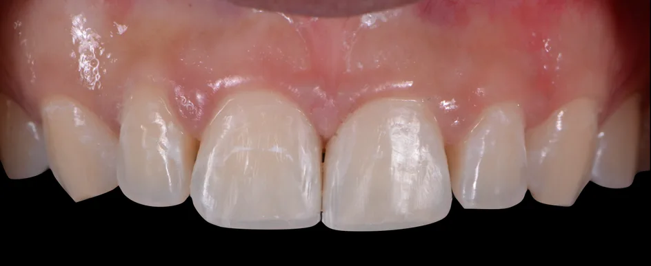 Bonding – after treatment, case 4 – Uptown Dentistry