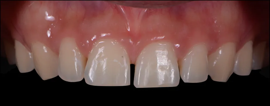 Bonding – before treatment, case 4 – Uptown Dentistry