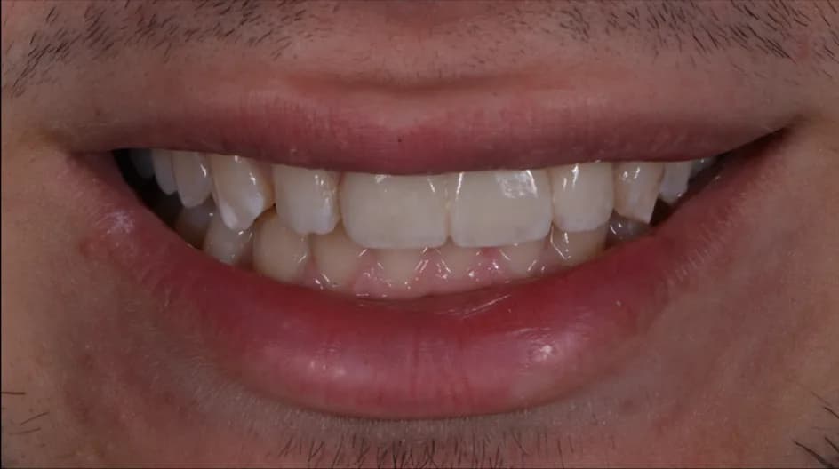 Crown & Bridges – after treatment, case 1 – Uptown Dentistry