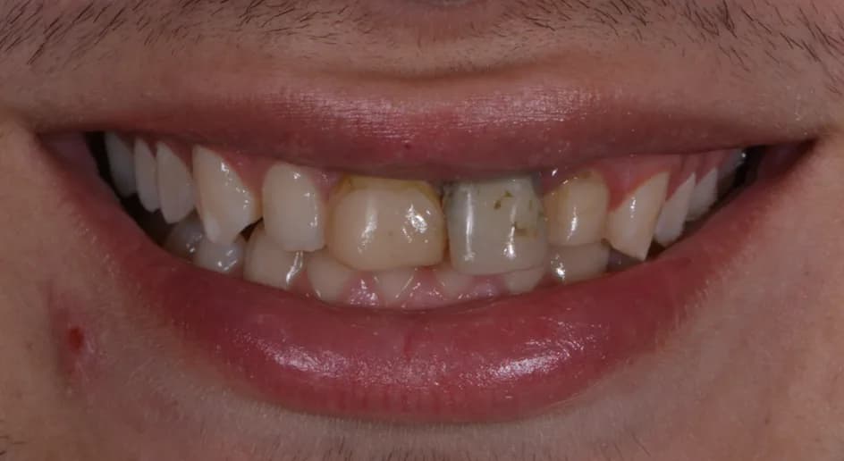 Crown & Bridges – before treatment, case 1 – Uptown Dentistry