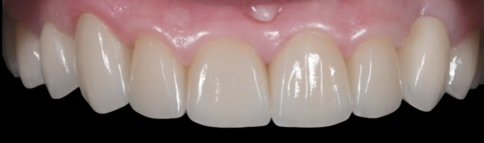 Crown & Bridges – after treatment, case 2 – Uptown Dentistry