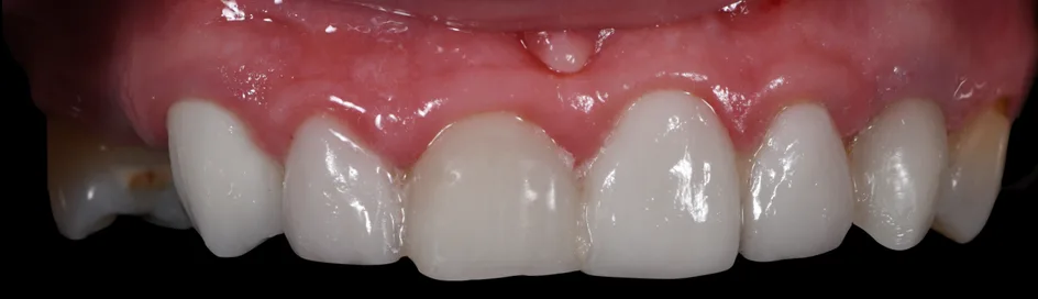 Crown & Bridges – before treatment, case 2 – Uptown Dentistry