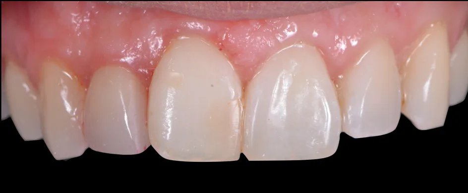 Crown & Bridges – after treatment, case 3 – Uptown Dentistry