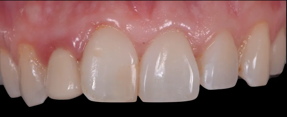 Crown & Bridges – before treatment, case 3 – Uptown Dentistry