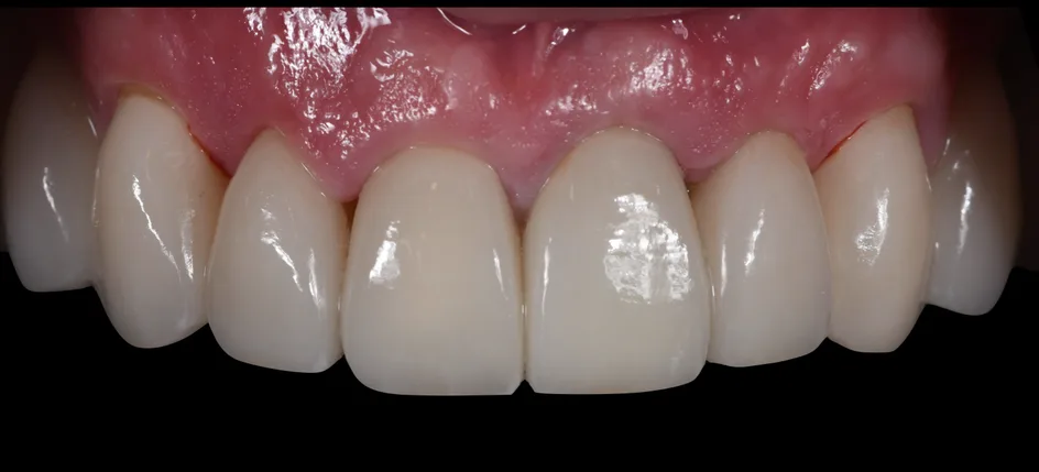 Crown & Bridges – after treatment, case 4 – Uptown Dentistry
