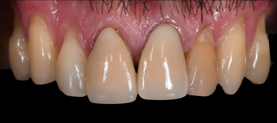 Crown & Bridges – before treatment, case 4 – Uptown Dentistry