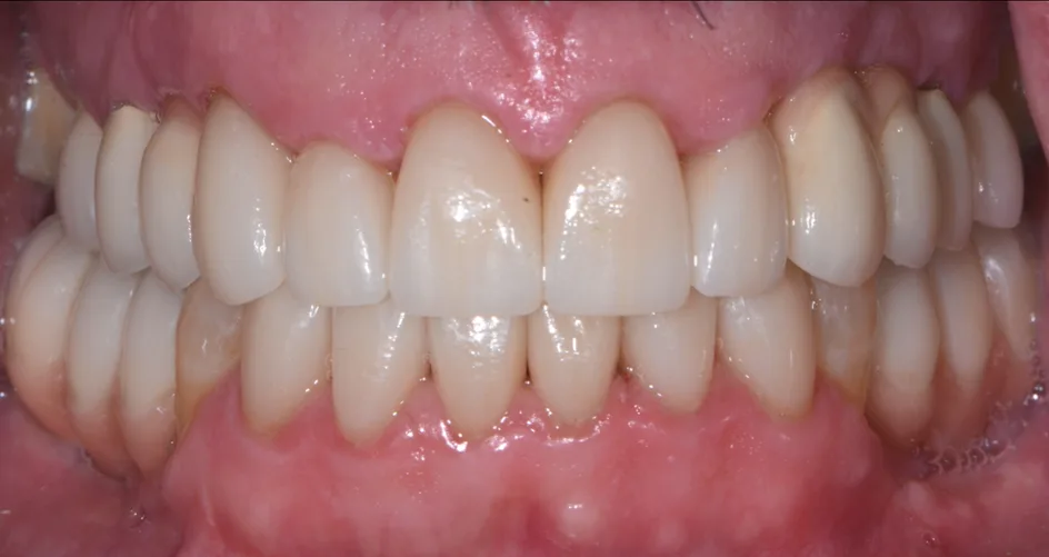 Crown & Bridges – after treatment, case 5 – Uptown Dentistry