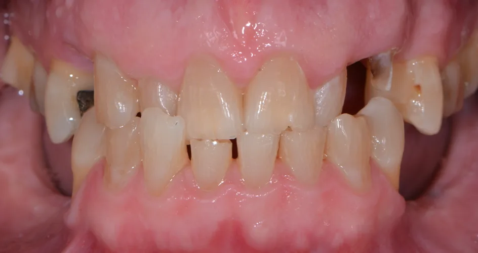 Crown & Bridges – before treatment, case 5 – Uptown Dentistry