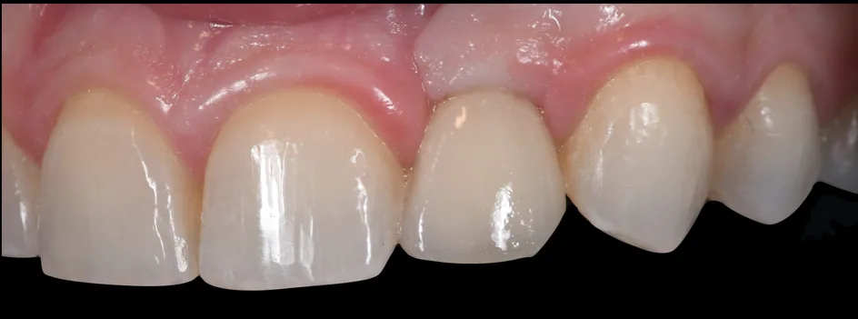 Implant Crowns – after treatment, case 1 – Uptown Dentistry