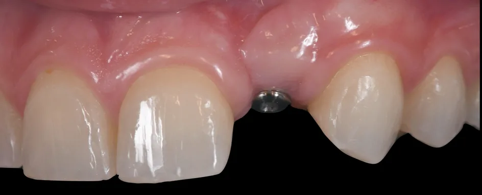 Implant Crowns – before treatment, case 1 – Uptown Dentistry
