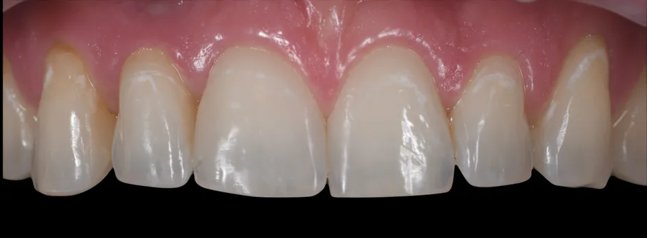 Implant Crowns – after treatment, case 2 – Uptown Dentistry