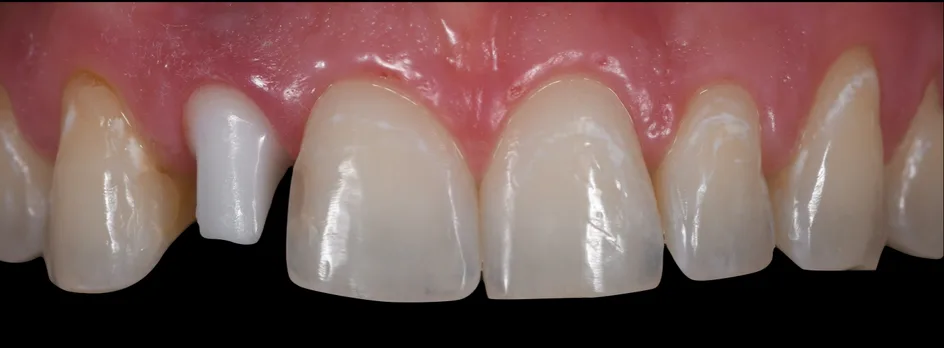 Implant Crowns – before treatment, case 2 – Uptown Dentistry