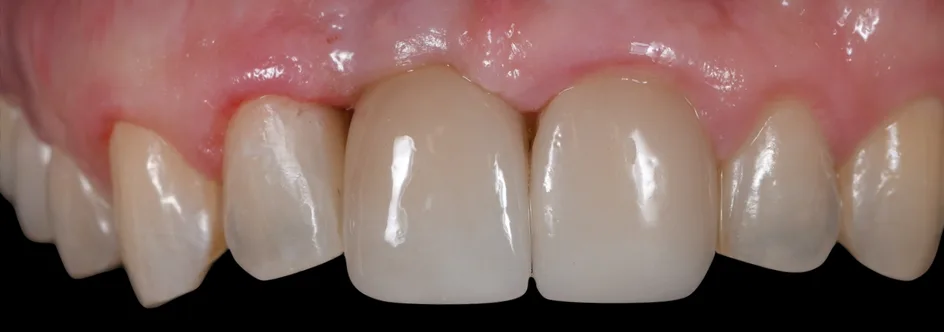 Implant Crowns – after treatment, case 3 – Uptown Dentistry