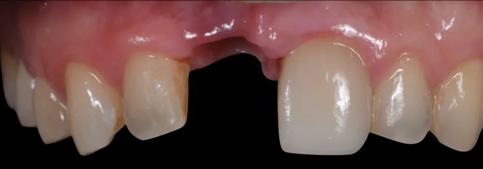 Implant Crowns – before treatment, case 3 – Uptown Dentistry