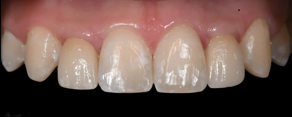 Implant Crowns – after treatment, case 4 – Uptown Dentistry