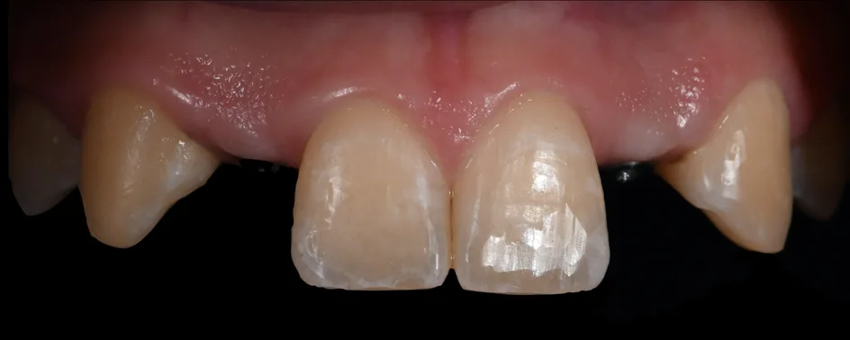 Implant Crowns – before treatment, case 4 – Uptown Dentistry