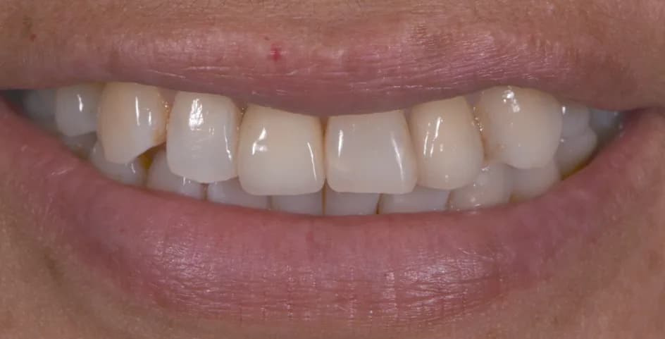 Implant Crowns – after treatment, case 5 – Uptown Dentistry
