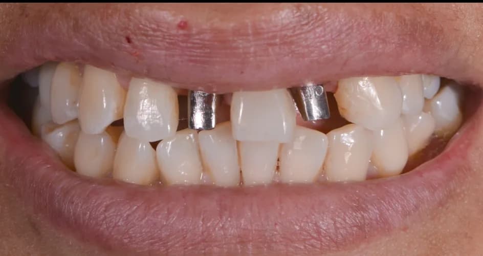 Implant Crowns – before treatment, case 5 – Uptown Dentistry