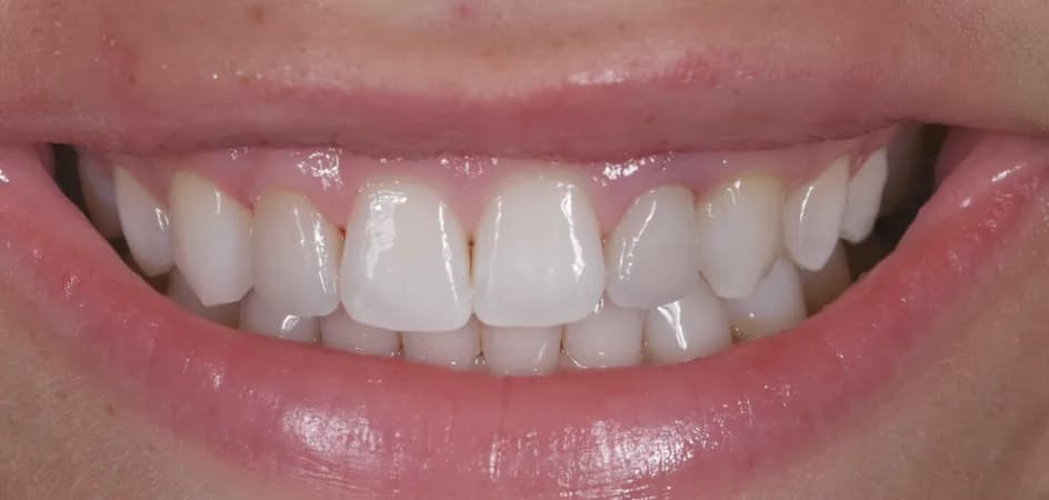 Implant Crowns – after treatment, case 6 – Uptown Dentistry