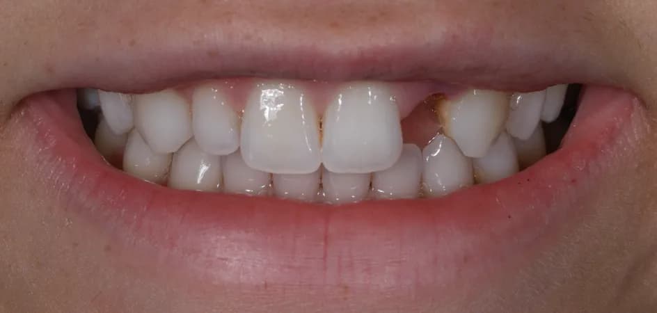 Implant Crowns – before treatment, case 6 – Uptown Dentistry