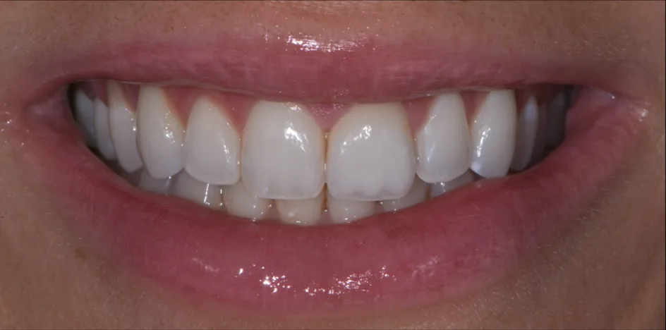 Veneers – after treatment, case 1 – Uptown Dentistry