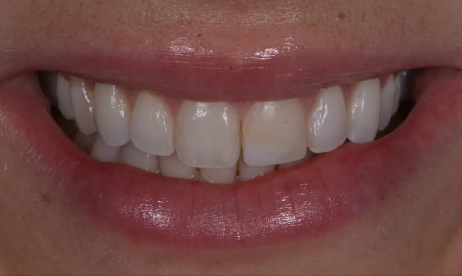 Veneers – before treatment, case 1 – Uptown Dentistry
