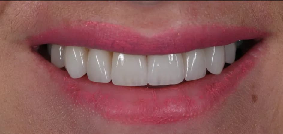 Veneers – after treatment, case 2 – Uptown Dentistry