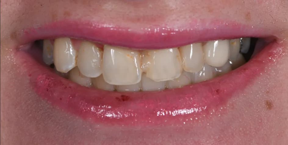 Veneers – before treatment, case 2 – Uptown Dentistry