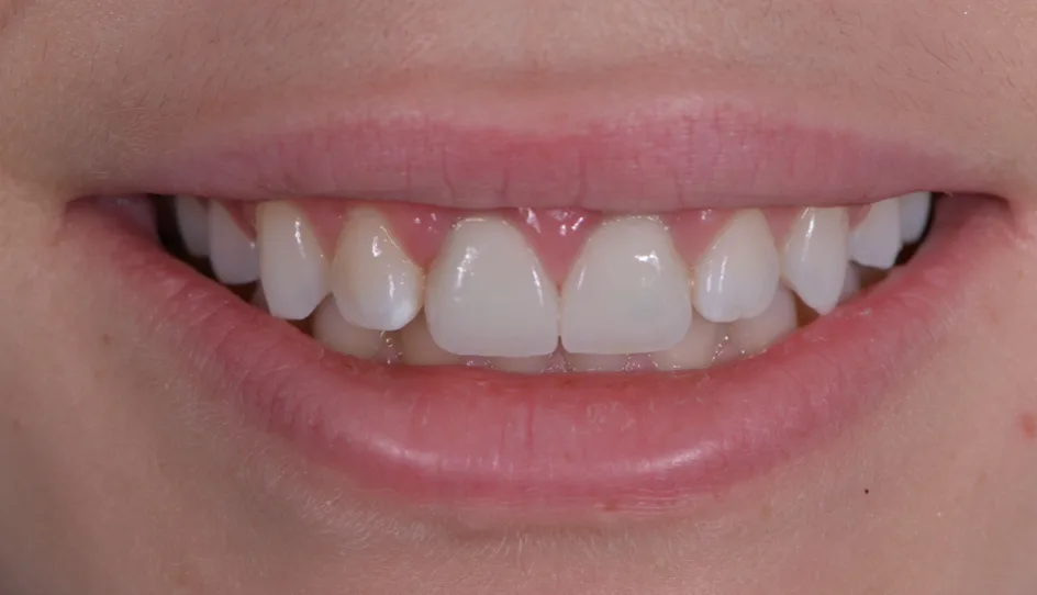 Veneers – after treatment, case 3 – Uptown Dentistry