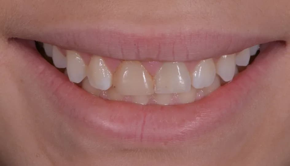 Veneers – before treatment, case 3 – Uptown Dentistry