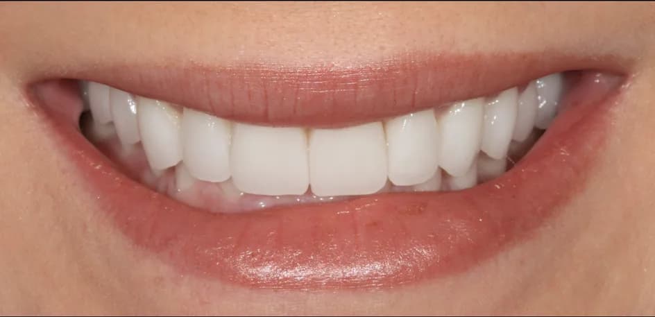 Veneers – after treatment, case 4 – Uptown Dentistry