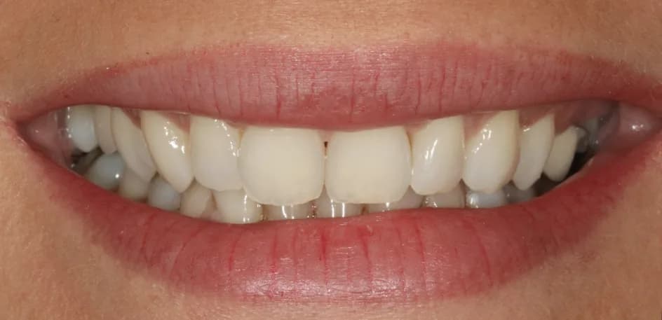 Veneers – before treatment, case 4 – Uptown Dentistry