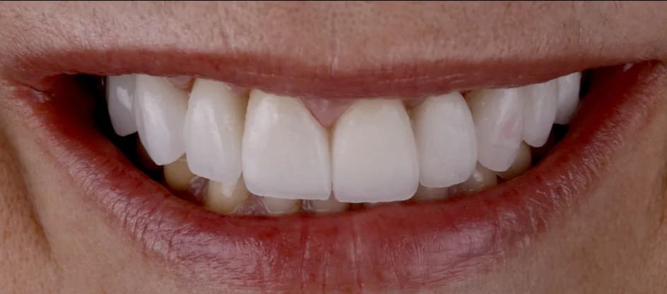 Veneers – after treatment, case 5 – Uptown Dentistry