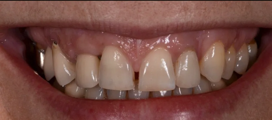 Veneers – before treatment, case 5 – Uptown Dentistry